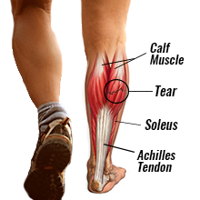 Healthy Street - CALF STRAIN AND HOW TO FIX IT A calf strain is a tear of  the muscle fibres of the muscles at the back of the lower leg and can
